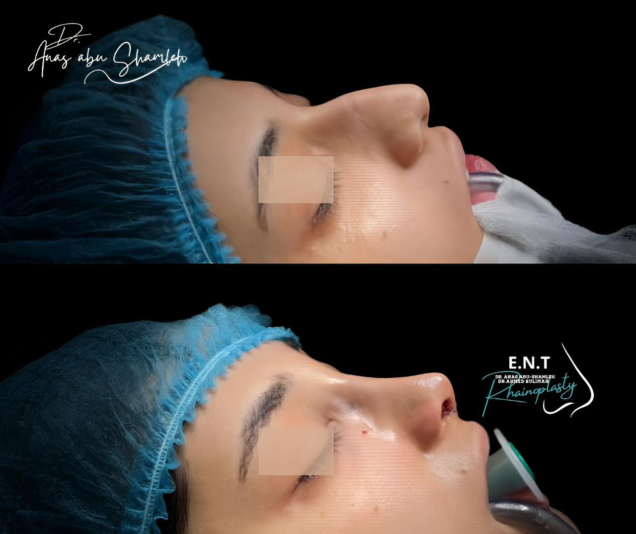 الدكتور أنس ابوشملة - أفضل دكتور انف واذن وجنجرة في الأردن - Dr. Anas Abu Shamleh - Ear, Nose, Throat Specialist and Rhinoplasty Surgeon