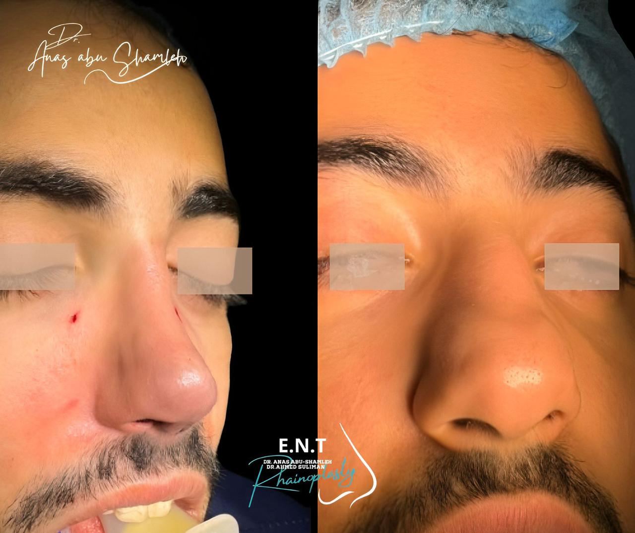 الدكتور أنس ابوشملة - أفضل دكتور تجميل أنف في الأردن - Dr. Anas Abu Shamleh - Ear, Nose, Throat
Specialist and Rhinoplasty Surgeon
