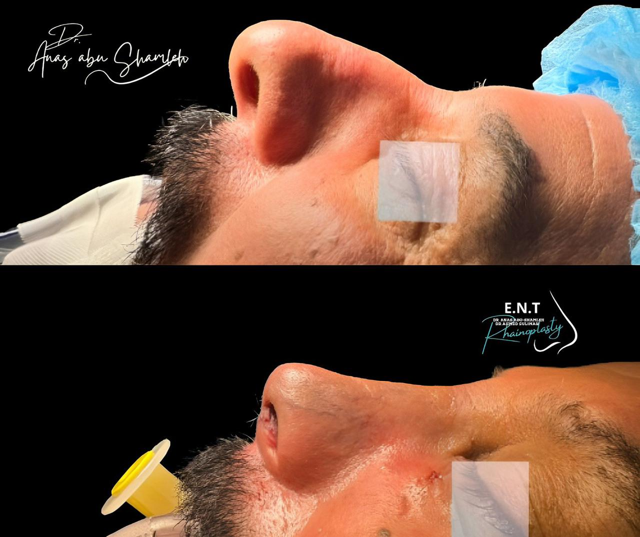 الدكتور أنس ابوشملة - أفضل دكتور تجميل أنف في الأردن - Dr. Anas Abu Shamleh - Ear, Nose, Throat
Specialist and Rhinoplasty Surgeon
