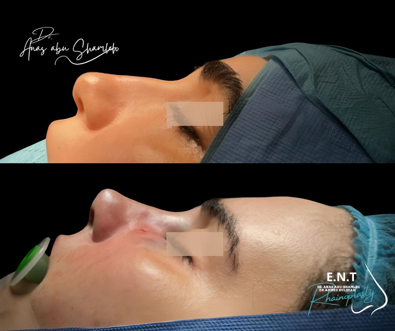 الدكتور أنس ابوشملة - أفضل دكتور تجميل أنف في الأردن - Dr. Anas Abu Shamleh - Ear, Nose, Throat
Specialist and Rhinoplasty Surgeon

