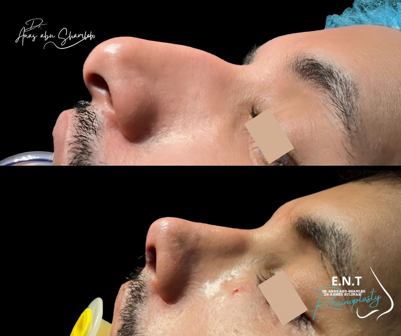 الدكتور أنس ابوشملة - أفضل دكتور تجميل أنف في الأردن - Dr. Anas Abu Shamleh - Ear, Nose, Throat
Specialist and Rhinoplasty Surgeon

