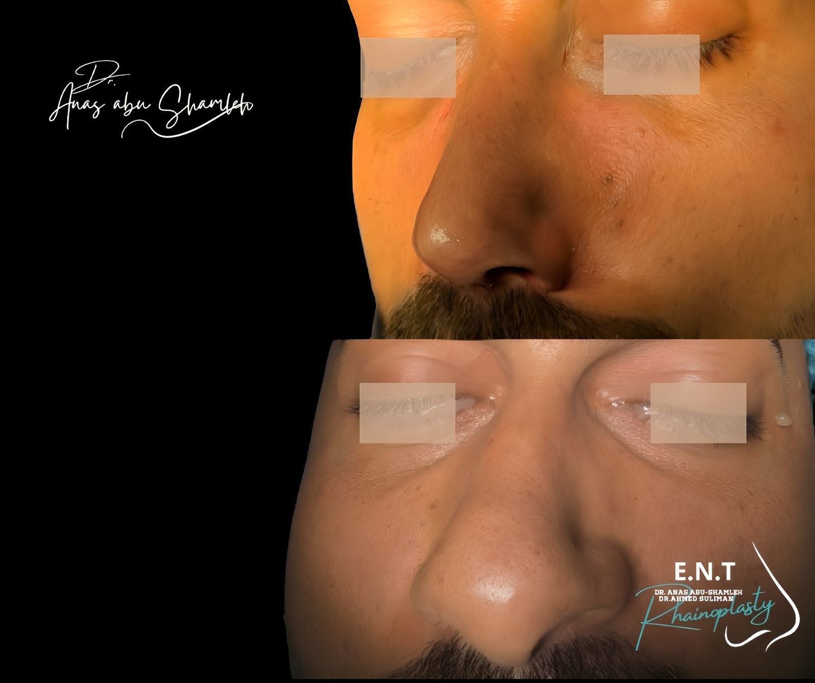 الدكتور أنس ابوشملة - أفضل دكتور تجميل أنف في الأردن - Dr. Anas Abu Shamleh - Ear, Nose, Throat
Specialist and Rhinoplasty Surgeon
