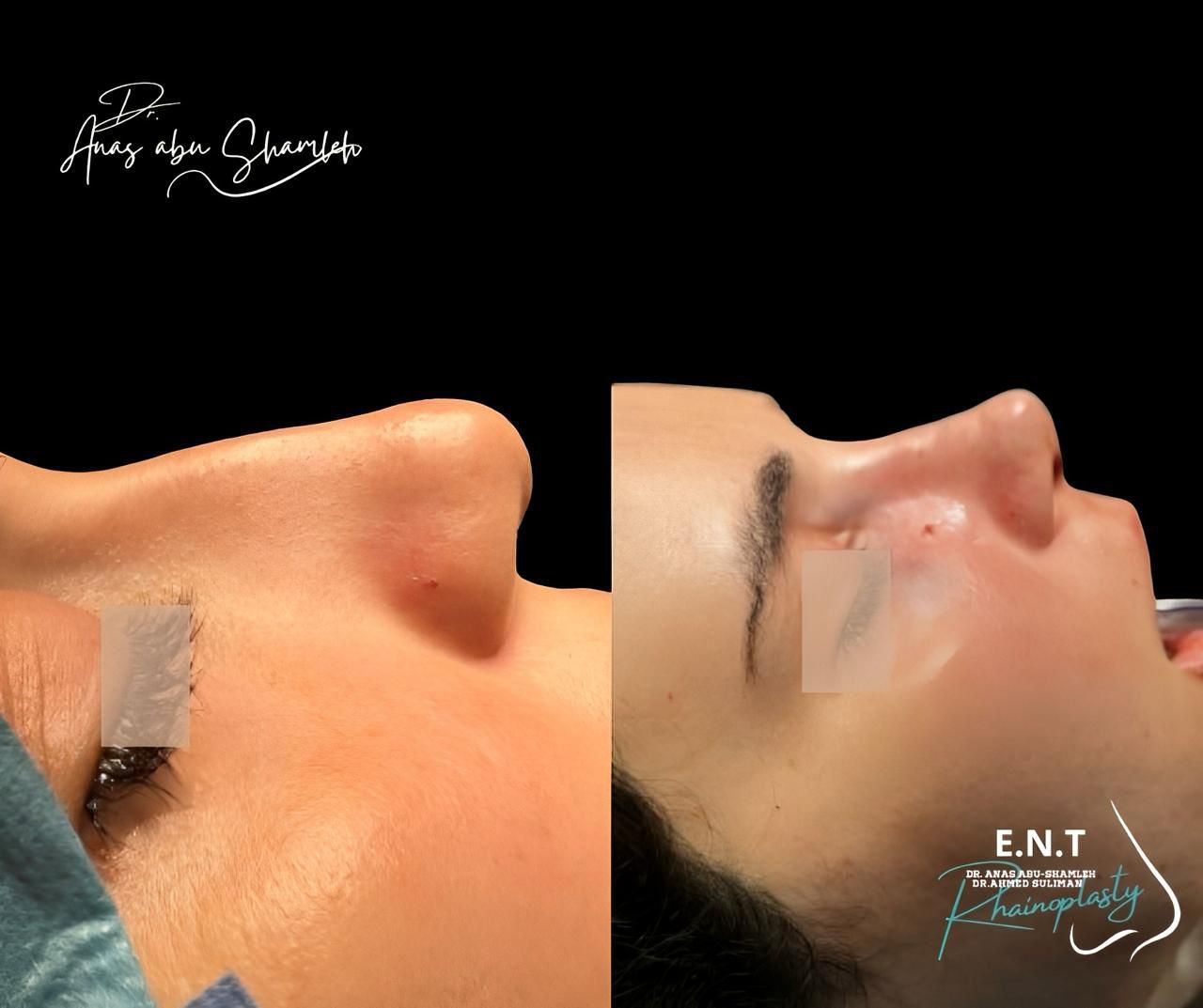 الدكتور أنس ابوشملة - أفضل دكتور تجميل أنف في الأردن - Dr. Anas Abu Shamleh - Ear, Nose, Throat
Specialist and Rhinoplasty Surgeon
