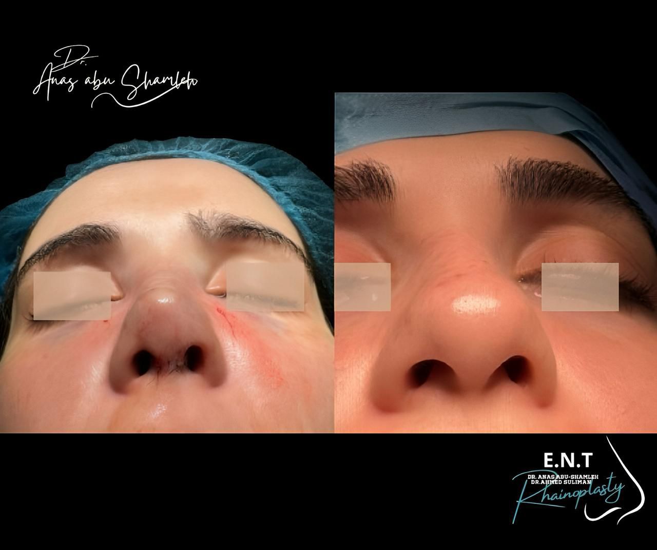 الدكتور أنس ابوشملة - أفضل دكتور أنف وأذن وجنجرة في الأردن - Dr. Anas Abu Shamleh - Ear, Nose, Throat
Specialist and Rhinoplasty Surgeon
