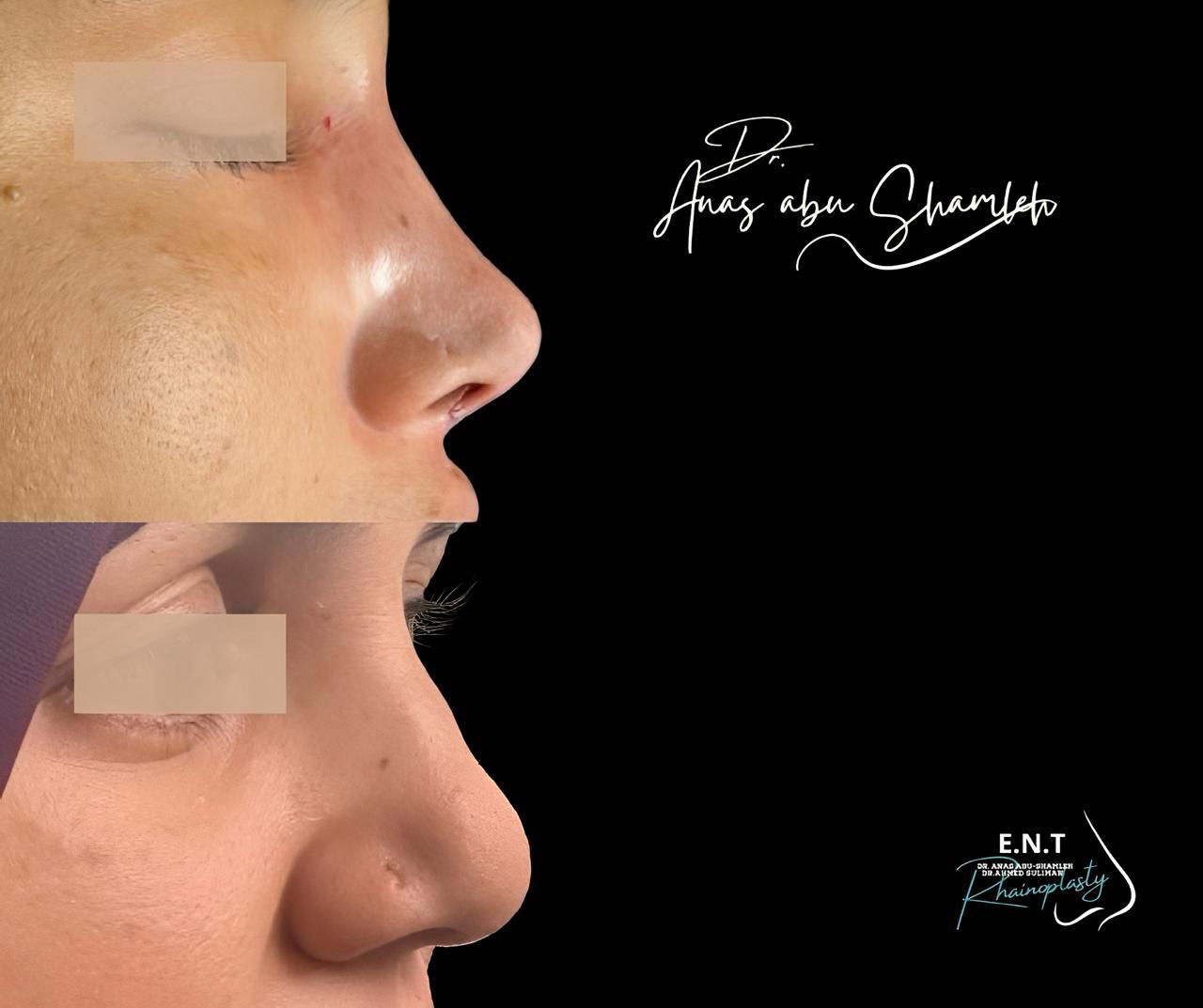 الدكتور أنس ابوشملة - أفضل دكتور أنف وأذن وجنجرة في الأردن - Dr. Anas Abu Shamleh - Ear, Nose, Throat
Specialist and Rhinoplasty Surgeon
