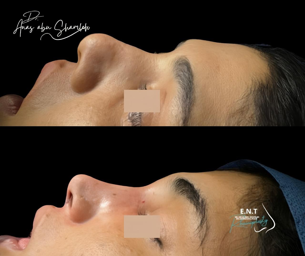 الدكتور أنس ابوشملة - أفضل دكتور أنف وأذن وجنجرة في الأردن - Dr. Anas Abu Shamleh - Ear, Nose, Throat
Specialist and Rhinoplasty Surgeon
