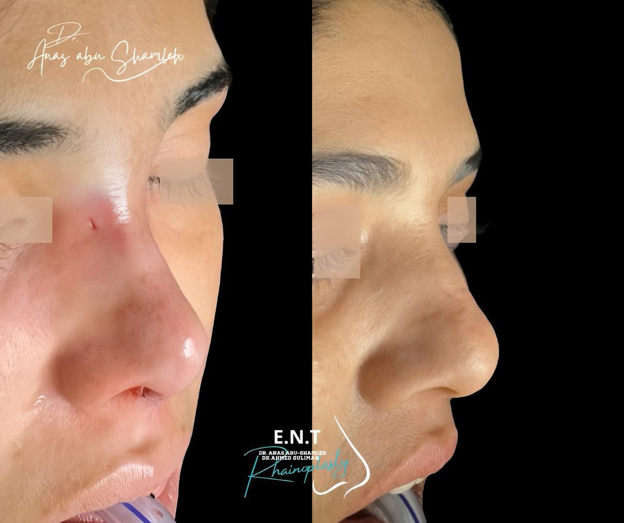 الدكتور أنس ابوشملة - أفضل دكتور انف واذن وجنجرة في الأردن - Dr. Anas Abu Shamleh - Ear, Nose, Throat Specialist and Rhinoplasty Surgeon