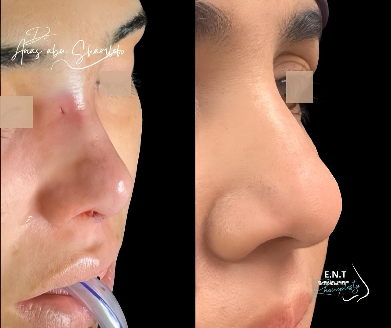 الدكتور أنس ابوشملة - أفضل دكتور انف واذن وجنجرة في الأردن - Dr. Anas Abu Shamleh - Ear, Nose, Throat Specialist and Rhinoplasty Surgeon