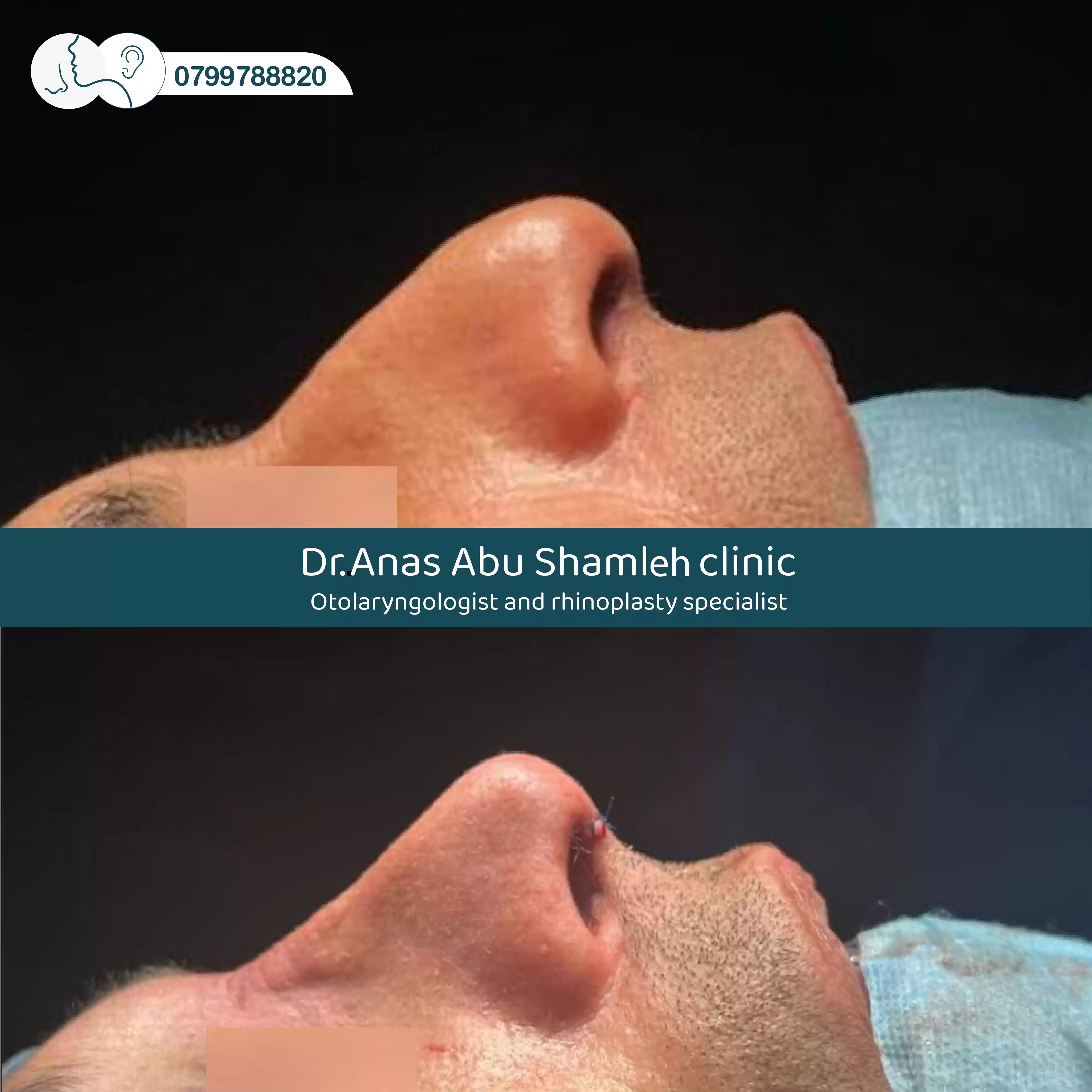 الدكتور أنس ابوشملة - أفضل دكتور أنف وأذن وجنجرة في الأردن - Dr. Anas Abu Shamleh - Ear, Nose, Throat
Specialist and Rhinoplasty Surgeon
