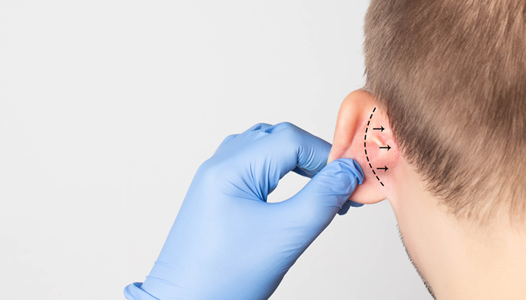 What is otoplasty