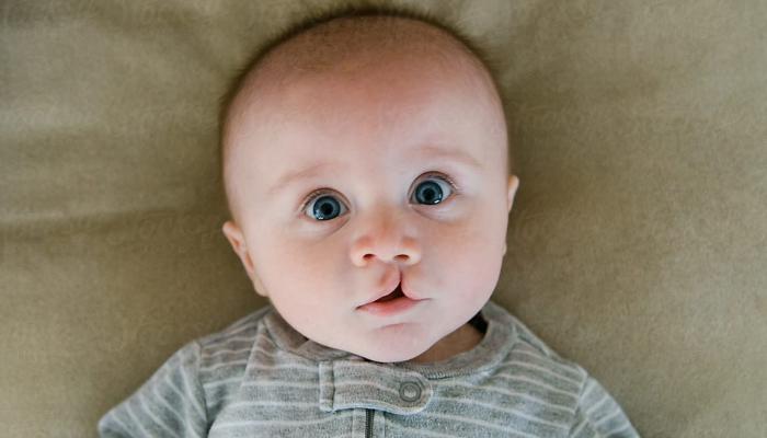 cleft lip