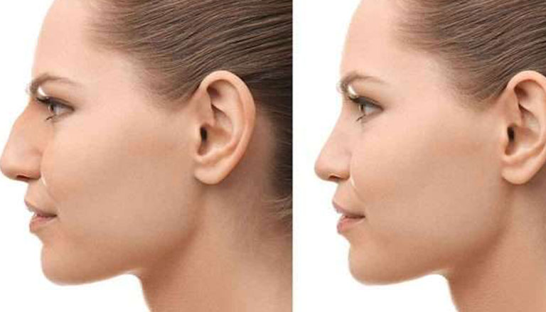 Types of rhinoplasty surgeries