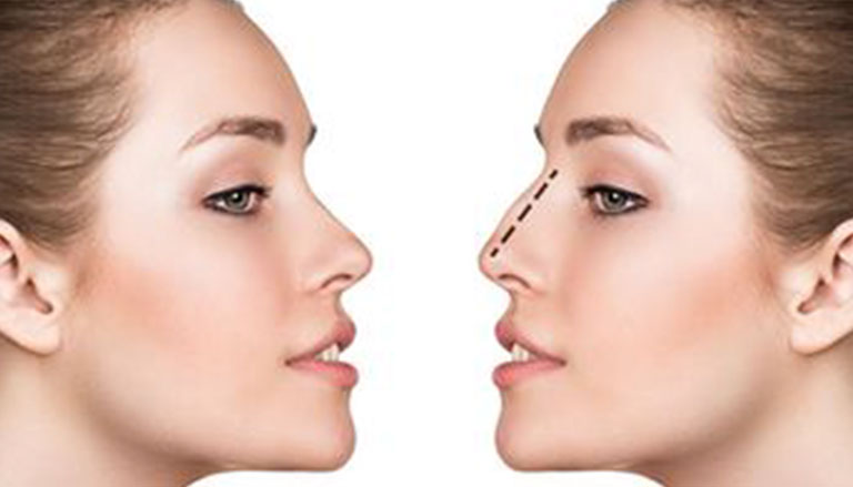 best rhinoplasty doctor in Jordan - Dr. Anas Abu Shamleh