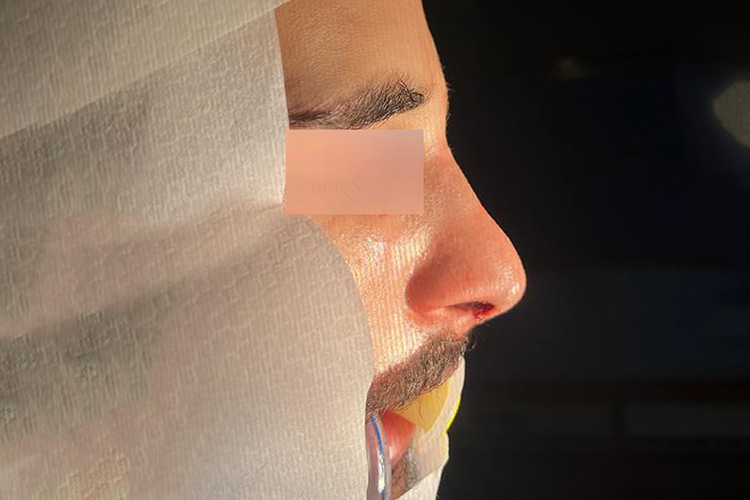  Before and After Rhinoplasty - Dr. Anas Abu Shamla, Consultant in ENT Surgeries and Sinus Endoscopy