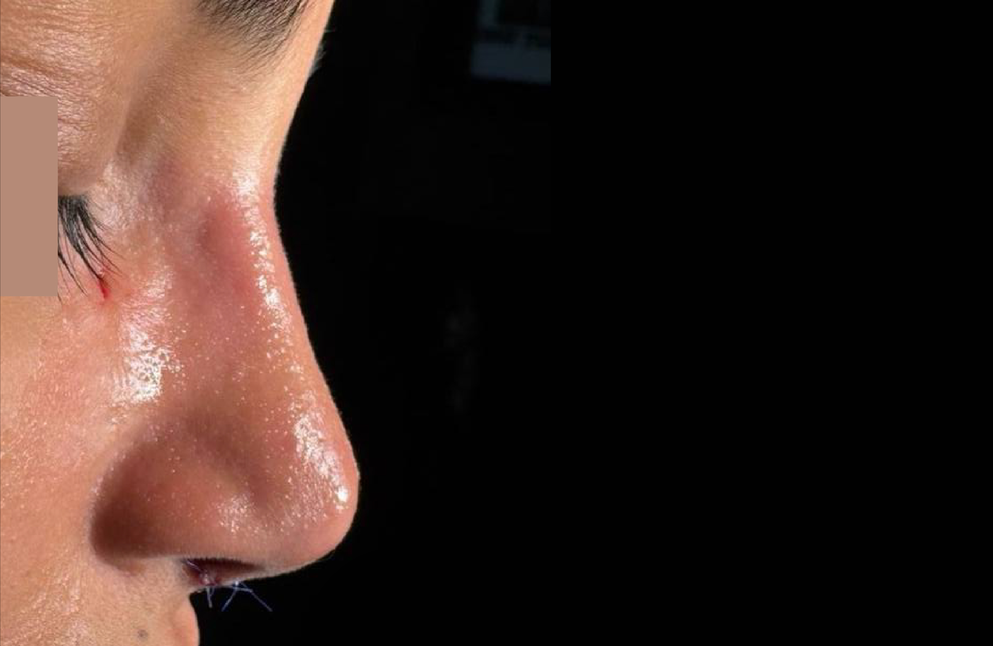  تجميل الأنف قبل وبعد مع الدكتور أنس أبو شملة – جراحة الأنف والأذن والحنجرة في عمان