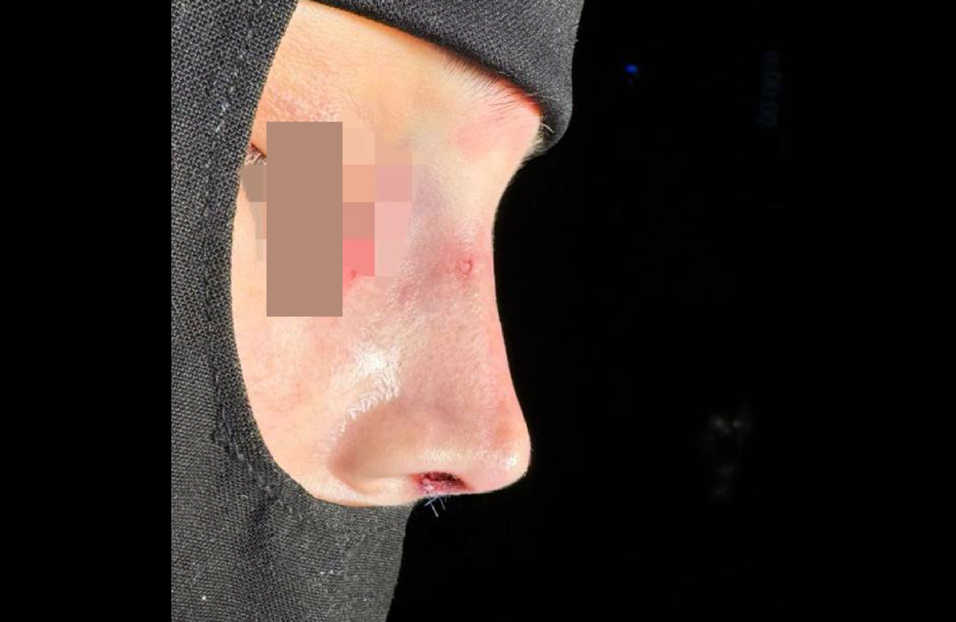  نتائج عملية تجميل الأنف قبل وبعد – تحت إشراف د. أنس أبو شملة